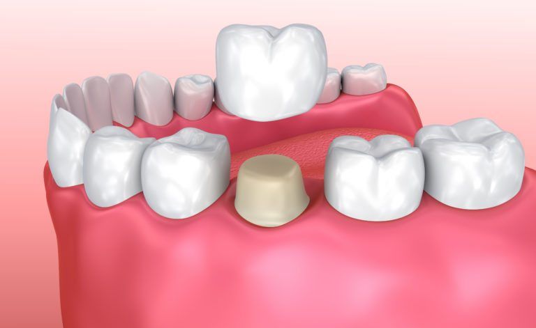 Dental crown installation process, Medically accurate 3d illustration crowndentaltoothceramicdentistry3d illustrationacheartificialbiteboerborerbucklercapscarecementcliniccobaltdefensedenturedrillhumaninstallationkeepinglablaboratoryloselowmacromedicalmedicinemetalprocessprosthesisprotectprotectionpulprecoveryrestorationrootsafeguardshieldstructuretemporarytreatmentShow more