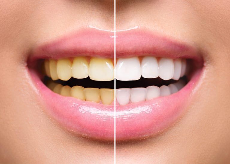 Close up of a before and after teeth whitening smile. Left side shows discolored teeth and right side shows whiter, brighter teeth after a professional teeth cleaning procedure.