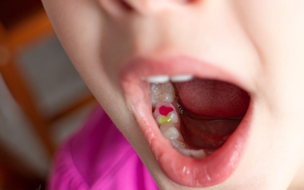 Child with Dental Filling