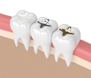 Composite vs amalgam fillings 3d model