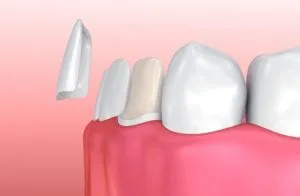 Computerized image of a porcelain veneer being applied to a tooth