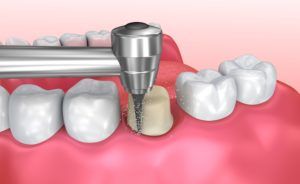 Computerized image showing how a tooth is prepared for a dental crown by enamel removal and reshaping