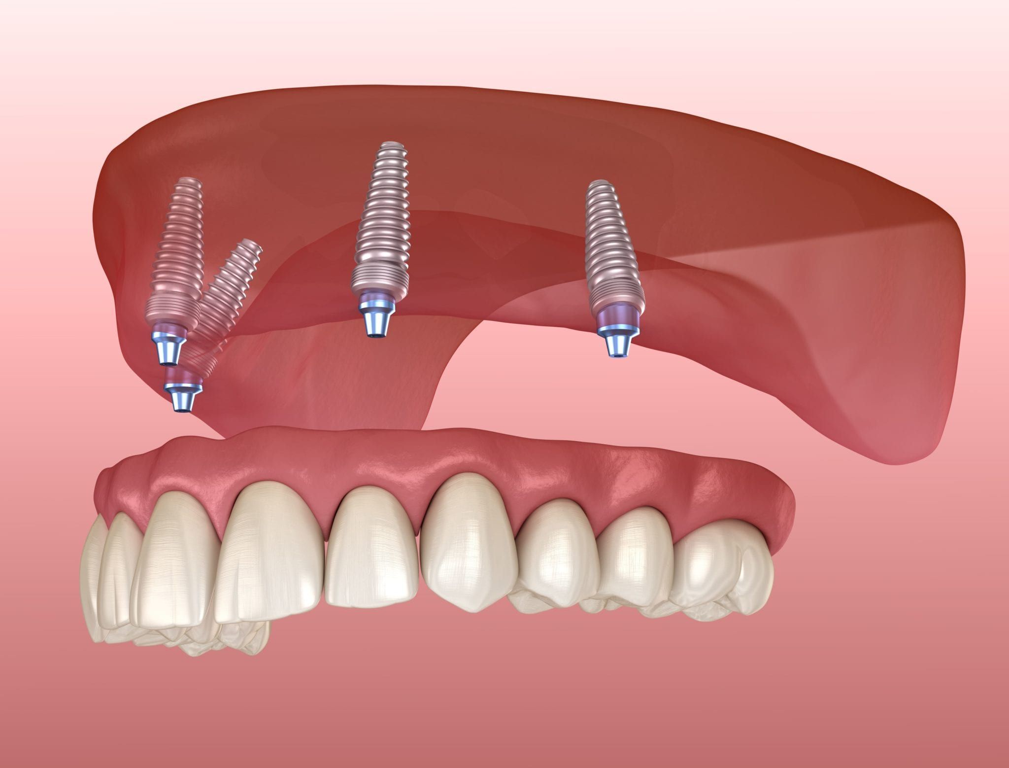 A denture that fits properly can change your life. 