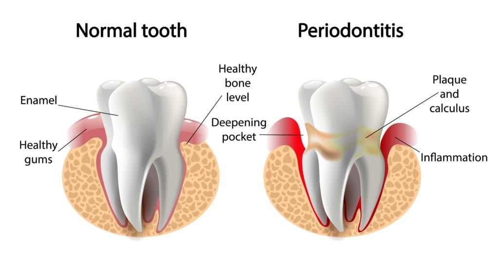 Normal tooth compared to tooth with periodontitis 