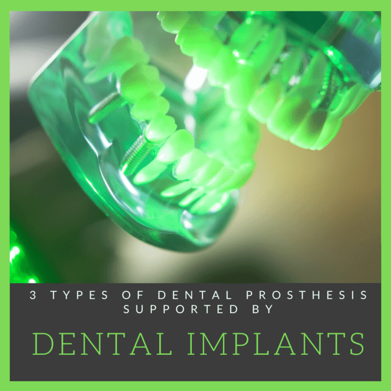 3 Dental Prosthesis Supported by Dental Implants