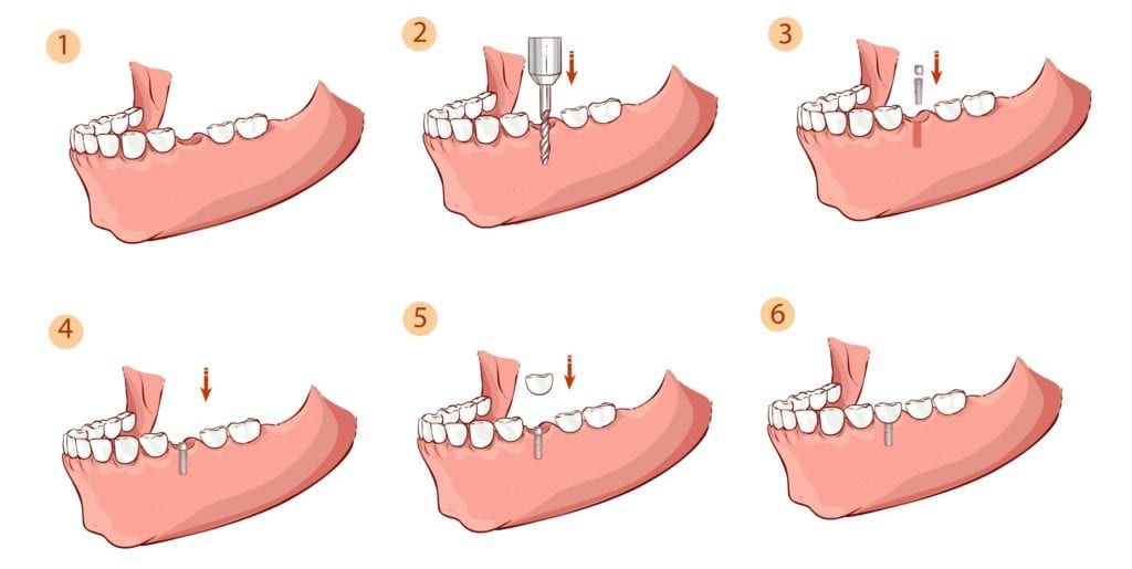 the six steps of the dental implant procedure