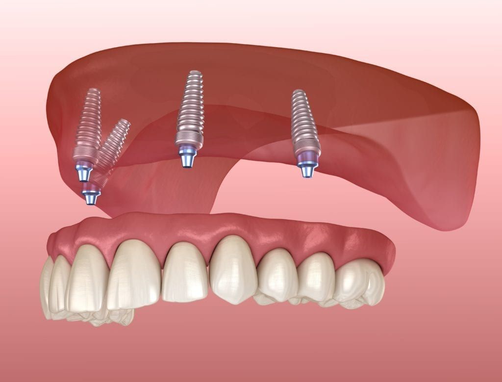 implant-supported denture