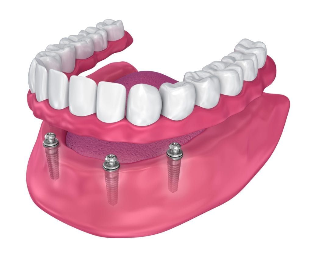 implant-supported dentures