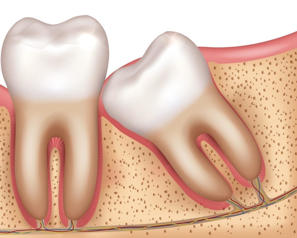 impacted wisdom tooth