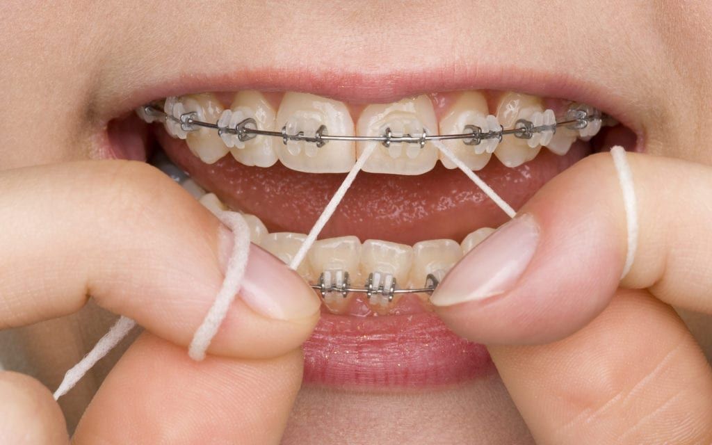 How to Floss Your Teeth With Braces - Tulsa Precision Dental