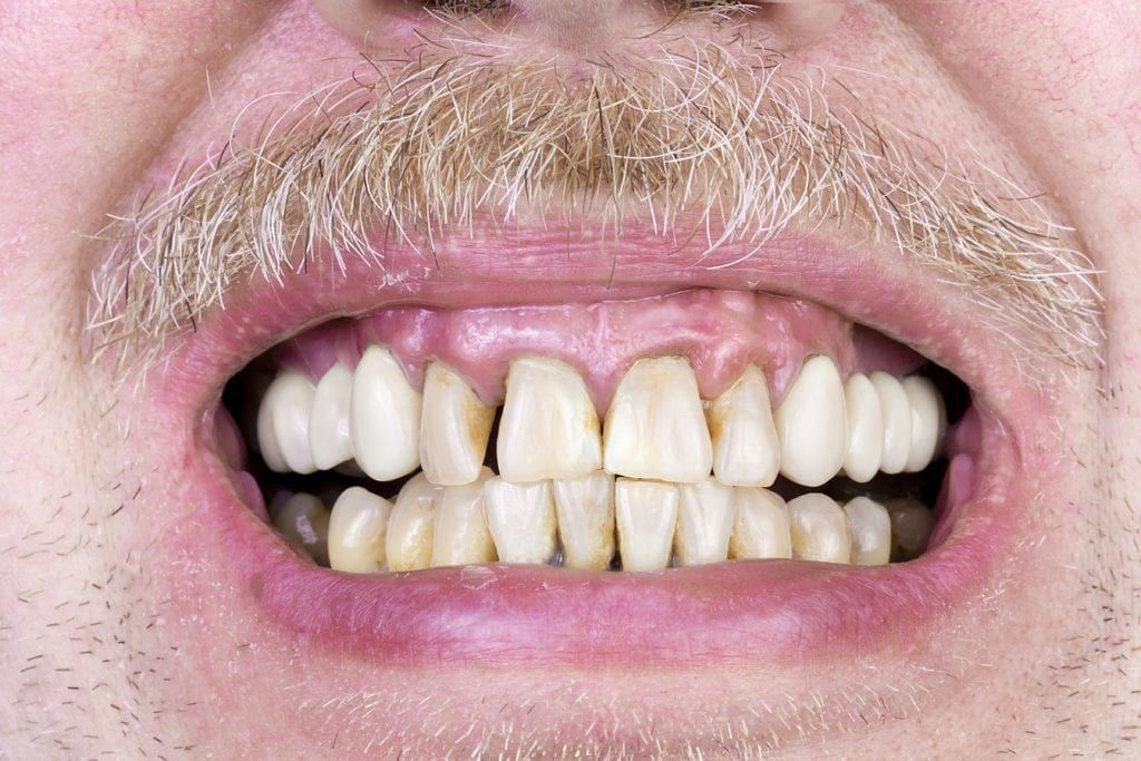 man smiling and showing teeth that have not had proper hygiene
