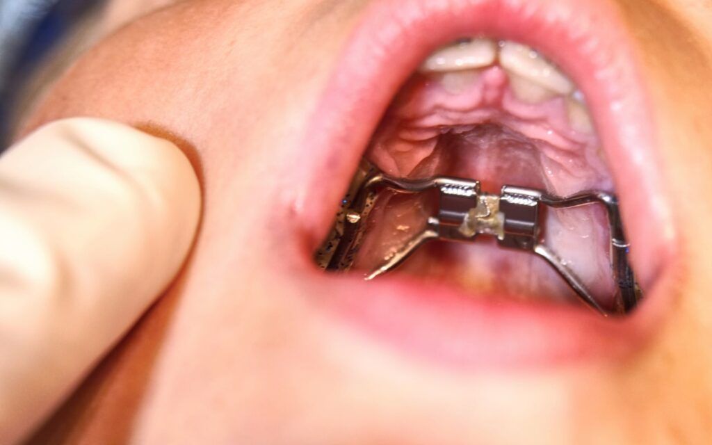 Braces for Adults - UD Implant Centers