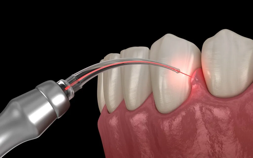 Enamel Sculpting