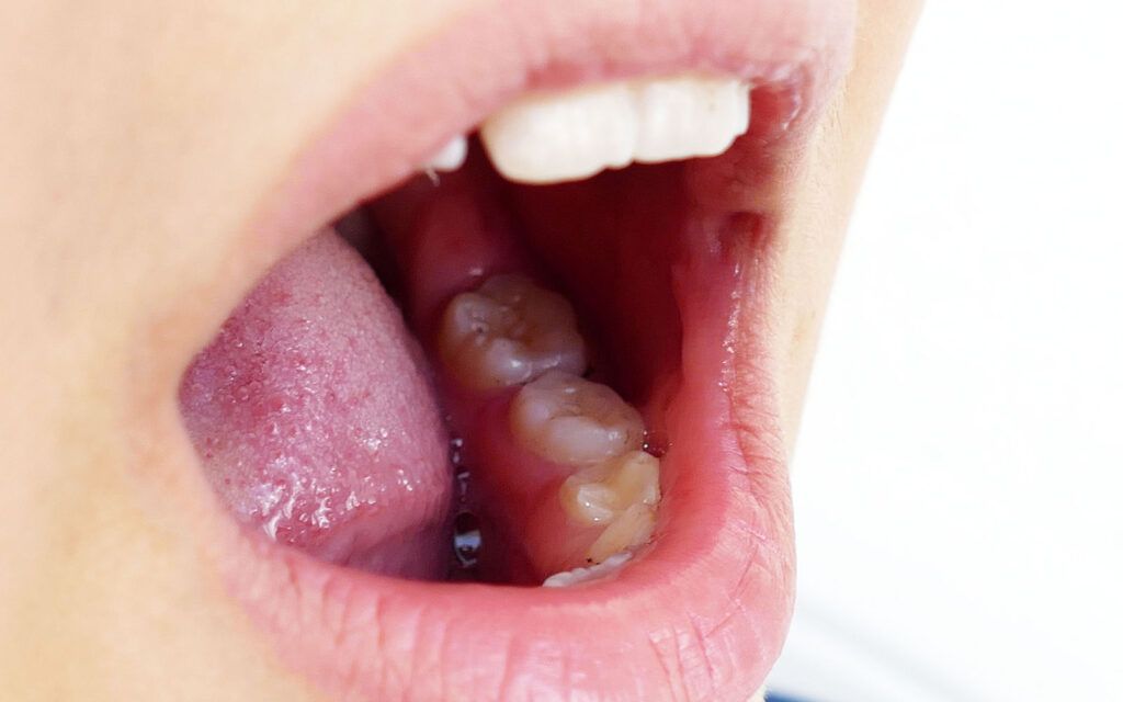 small black dot in mouth near tooth