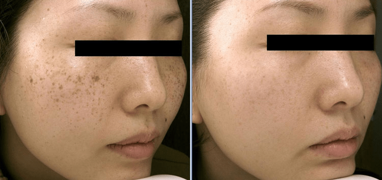 laser treatment for dark spots