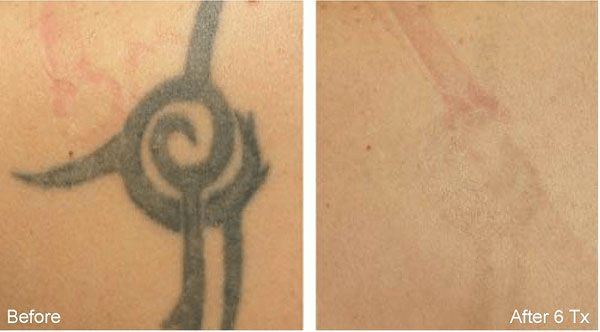 Tattoo Removal  Microblading and Permanent Makeup TIAN Studio