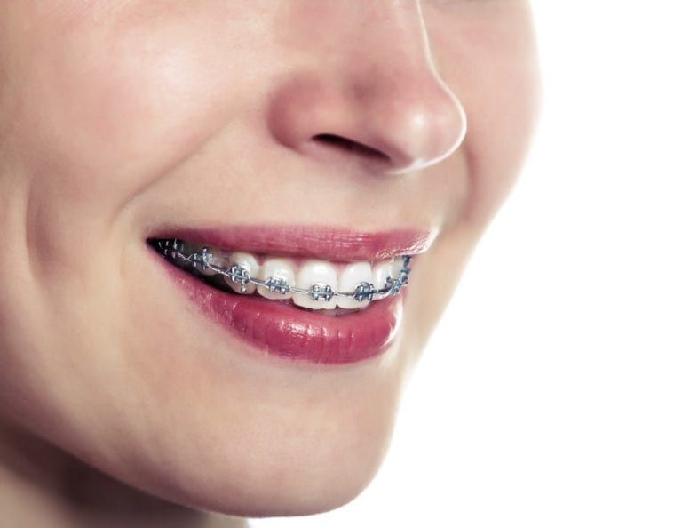 Metal Braces: Pros and Cons - Smiles Orthodontics