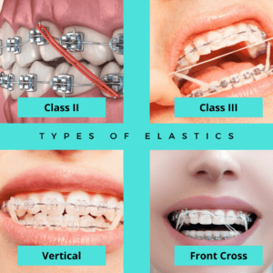 Types of Elastics