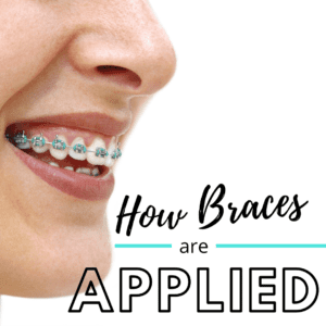 How Braces are Applied