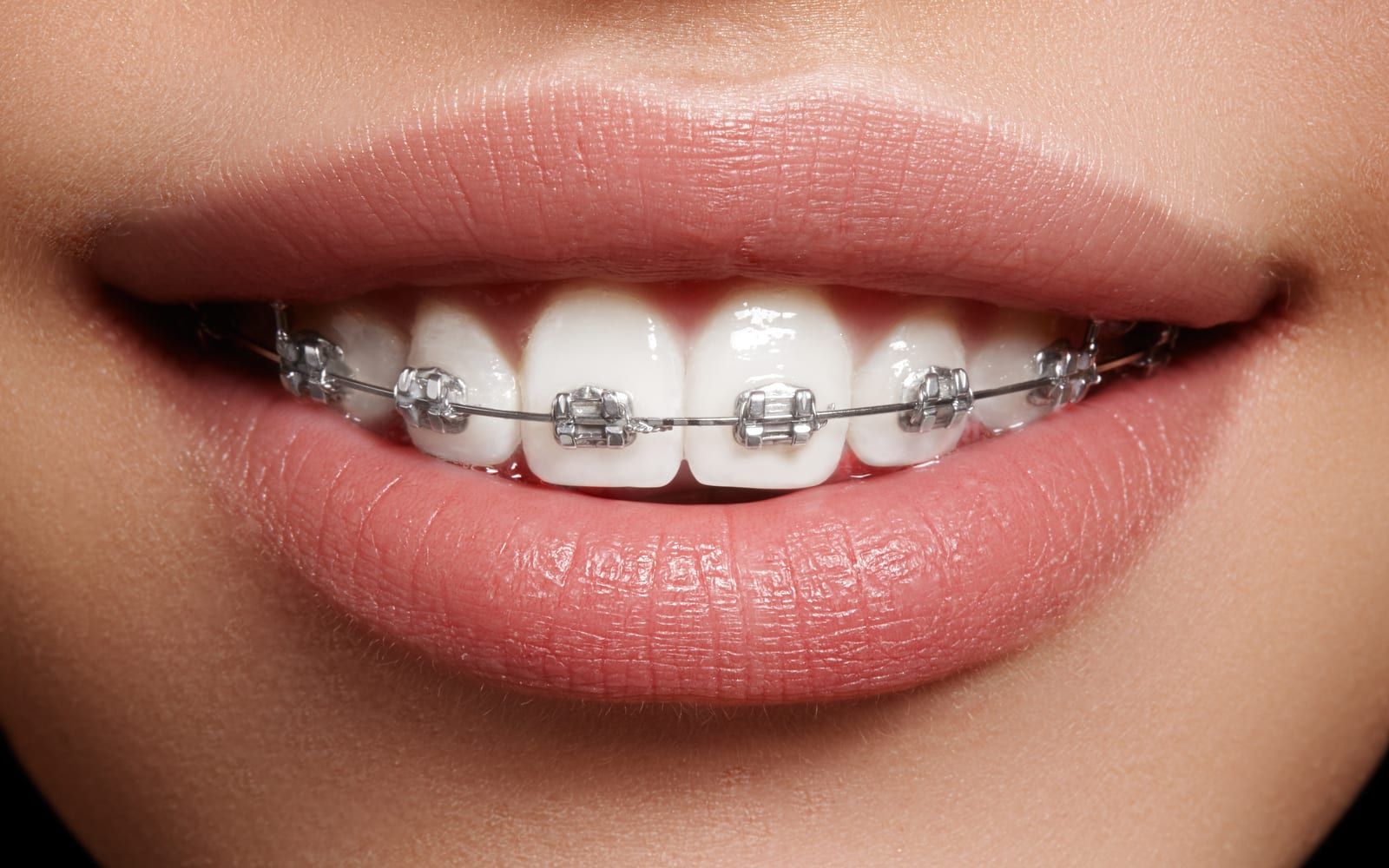 How Nickel, Copper, and Cobalt are Changing Braces - Massih