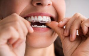 Woman Putting on Invisalign Aligners