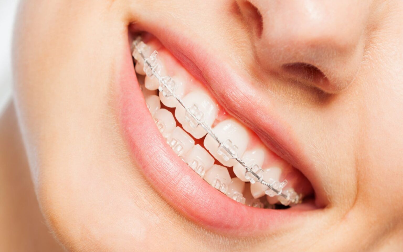 What to Know About Ceramic Braces Massih Orthodontics