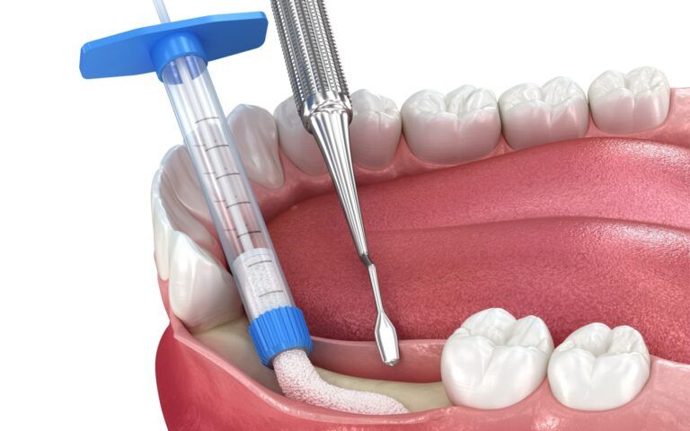 Bone graft image