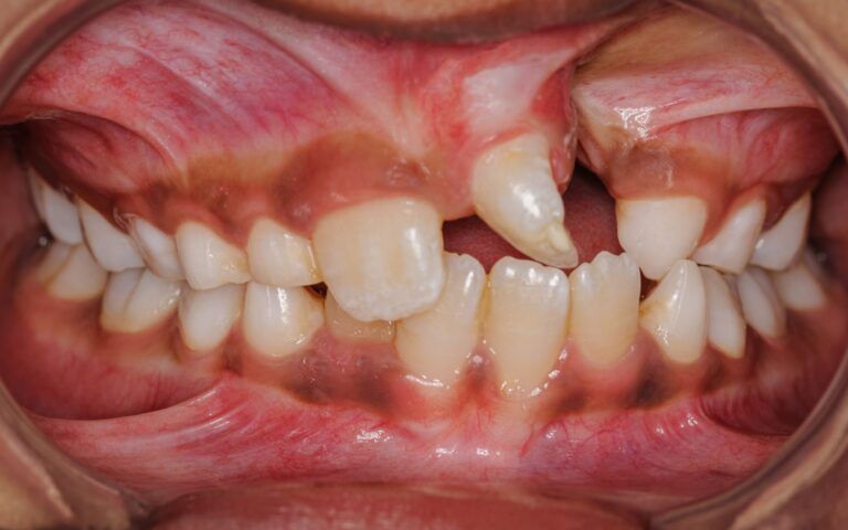 Teeth With Cleft Palate