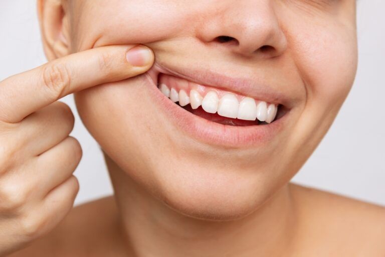 Lip Fillers for Gummy Smiles: What You Should Know