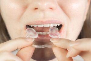 Woman puts Soft mouth guard for TMJ, TMD in her mouth