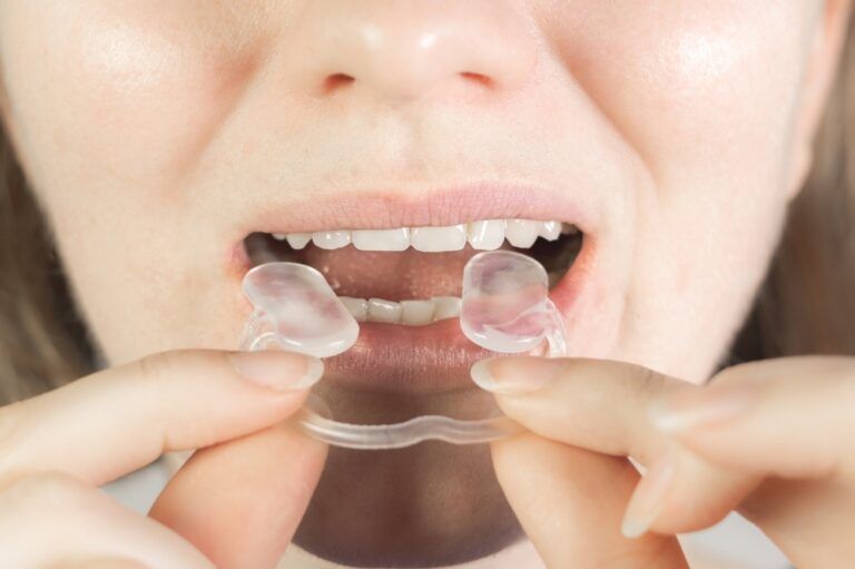 Woman puts Soft mouth guard for TMJ, TMD in her mouth