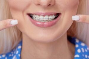 Beautiful macro shot of white teeth with braces.