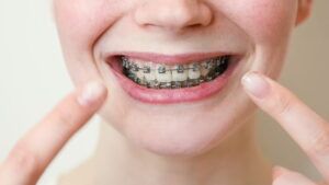 Close-up portrait of a young woman pointing at her smile with braces on her teeth.