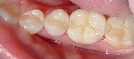 white-composite-fillings-after-2