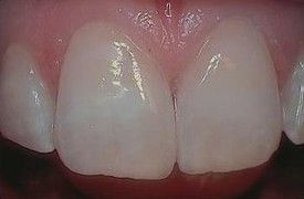 white-composite-fillings-after-4