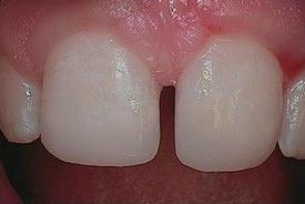 white-composite-fillings-after-5