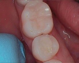 white-composite-fillings-after-7