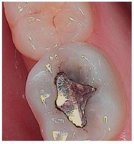 white-composite-fillings-before-1