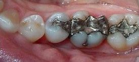 white-composite-fillings-before-2