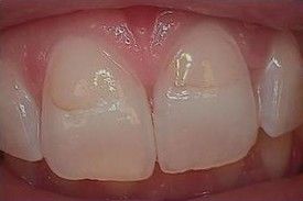 white-composite-fillings-before-4