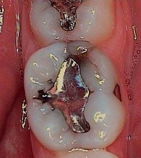 white-composite-fillings-before-6