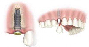 dental-implant-picture2
