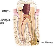 root-canal-explained