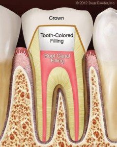 root-canal-finish