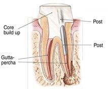 root-canal-middle