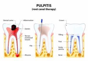 Diagram showing the various stages of a root canal