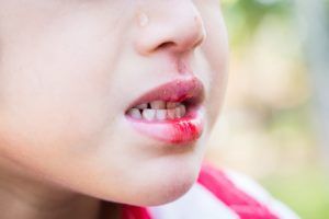 Boy will bleeding lip and hurt teeth