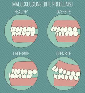 Chart showing different types of malocclusion 