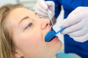 Woman biting down into a plastic tray to obtain a dental impression