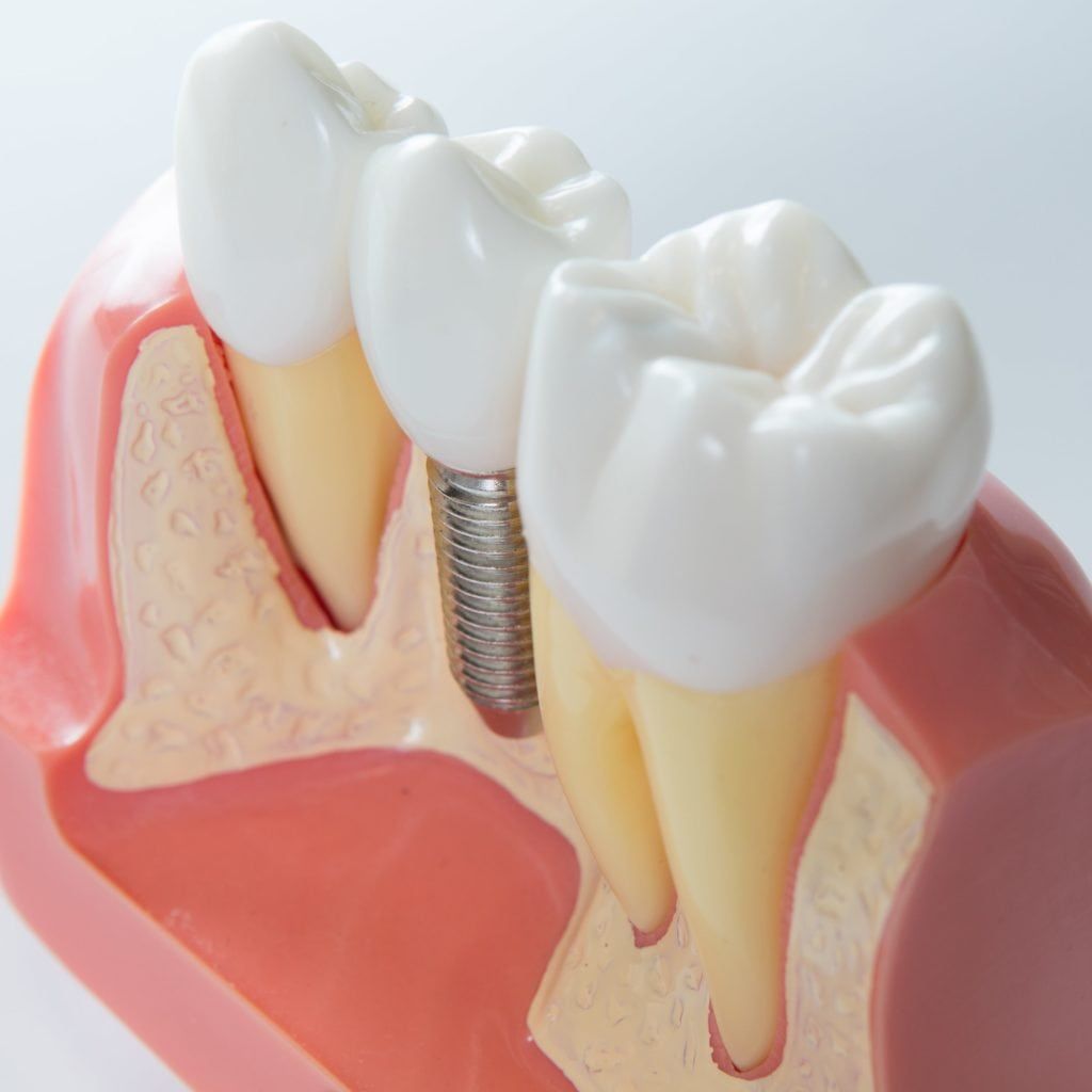 3d rendered image of a dental implant